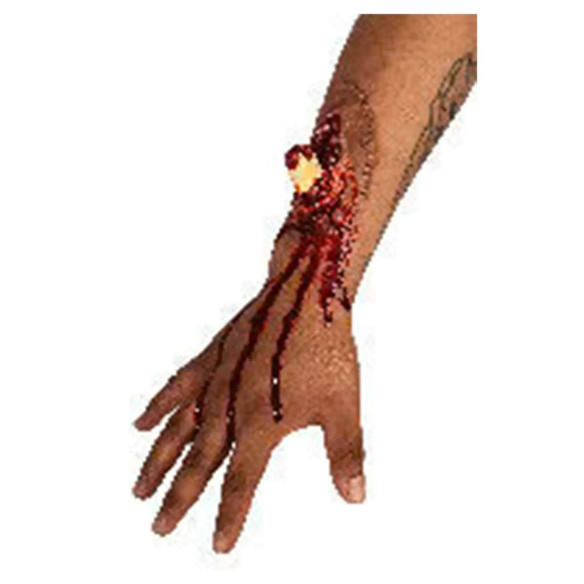 Broken Bone Prosthetic
